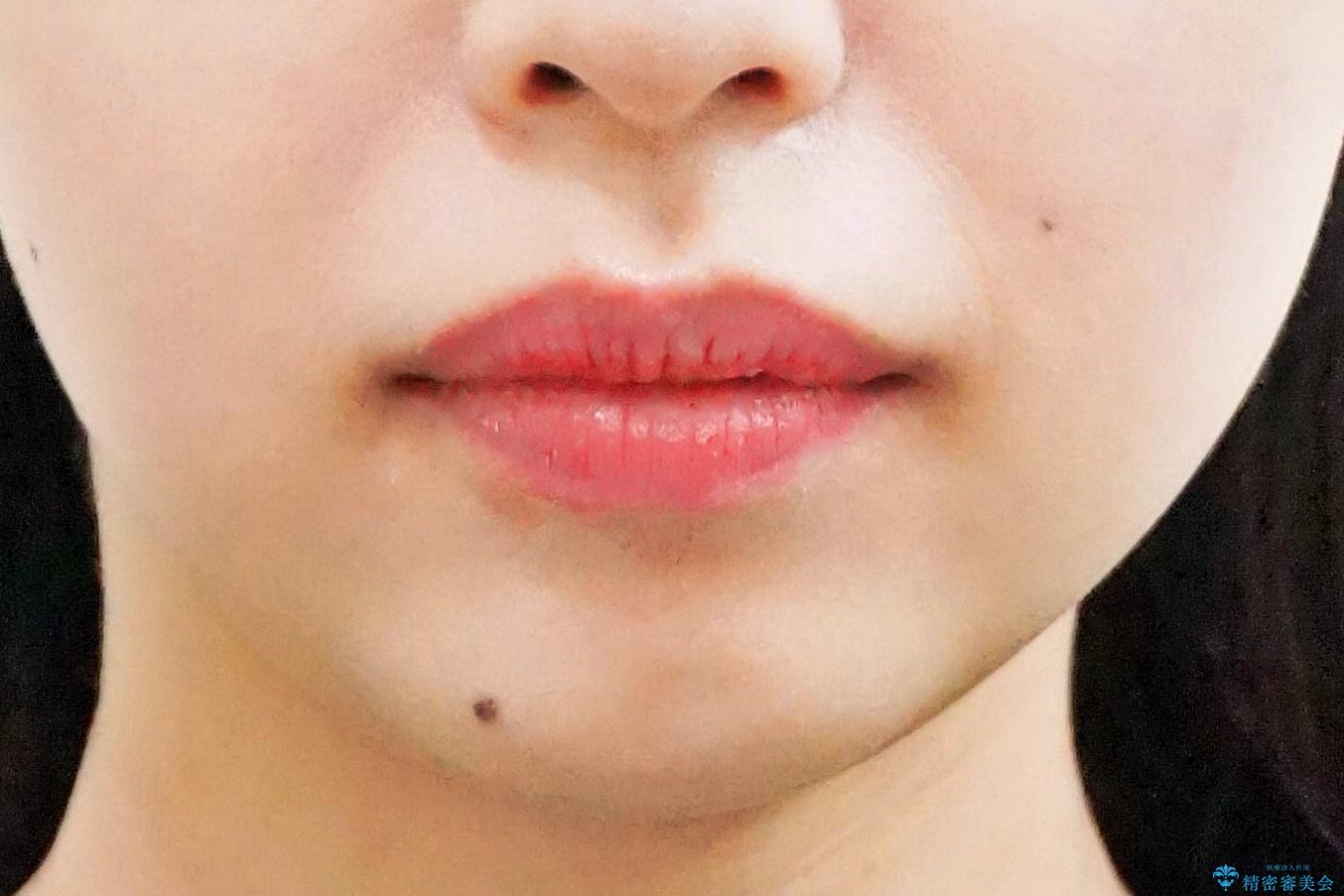 前歯の並び インビザライン 非抜歯で 深いかみ合わせの治療の治療前(顔貌)