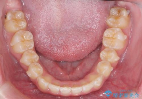 前歯の並び インビザライン 非抜歯で 深いかみ合わせの治療の治療中