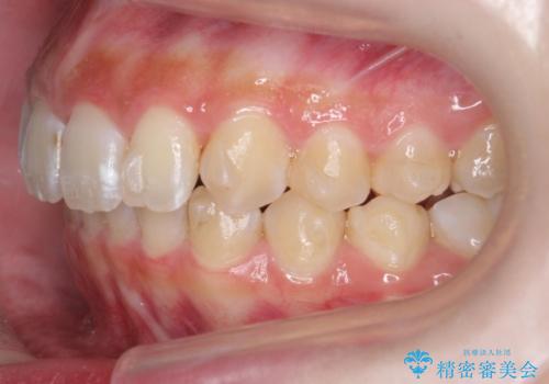 前歯の並び インビザライン 非抜歯で 深いかみ合わせの治療の治療中
