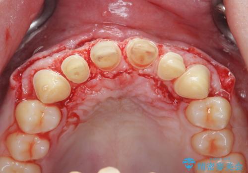 歯周外科を行い、歯ぐきの状態を整えた前歯セラミック治療の治療中