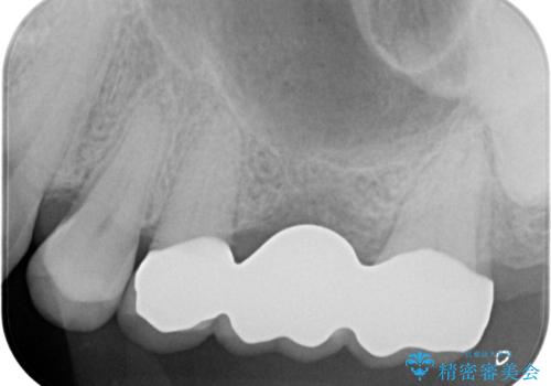 奥歯が痛む　ブリッジによる治療の治療後