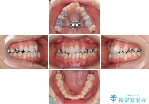 骨格的な問題を側方拡大で解決　ワイヤー矯正治療の治療中