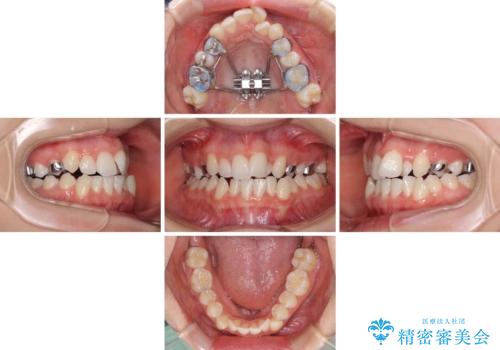 骨格的な問題を側方拡大で解決 ワイヤー矯正治療の治療中