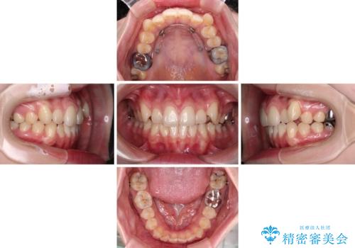 八重歯を確実に改善　補助装置を併用したインビザライン矯正治療の治療中