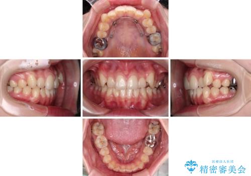 八重歯を確実に改善 補助装置を併用したインビザライン矯正治療の治療中