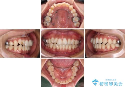 【モニター】上顎前突と奥歯の鋏状咬合 補助装置を用いたインビザライン矯正治療の治療中