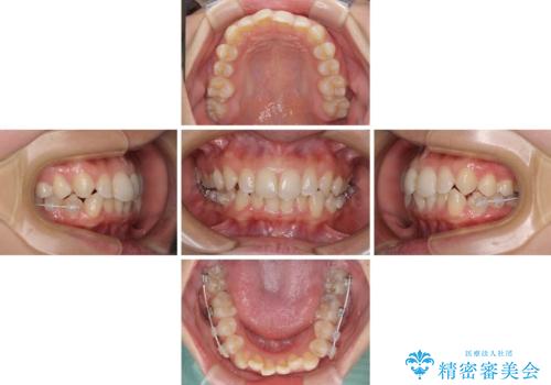埋もれた奥歯をワイヤーで改善　インビザラインによる矯正治療の治療中