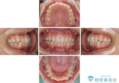 埋もれた奥歯をワイヤーで改善 インビザラインによる矯正治療の治療中