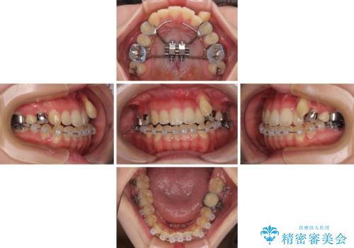 急速拡大装置　狭い上顎骨を拡大してワイヤー装置で八重歯を短期間治療の治療中