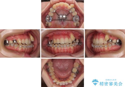 急速拡大装置 狭い上顎骨を拡大してワイヤー装置で八重歯を短期間治療の治療中