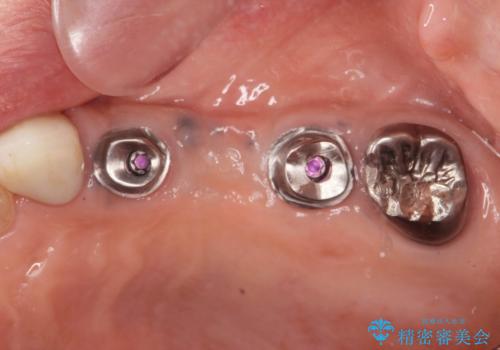 複数の奥歯の欠損 インプラントによる咬合機能回復の治療中