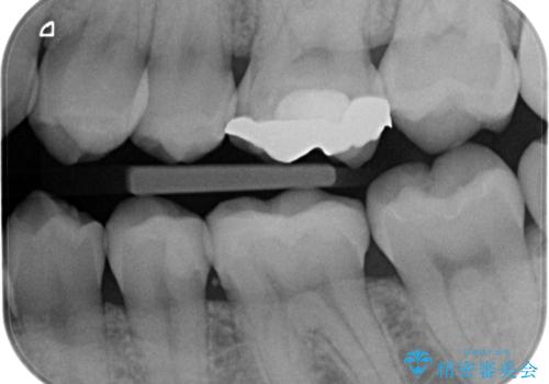 金の詰め物の中にある虫歯を除去してセラミック治療の治療前