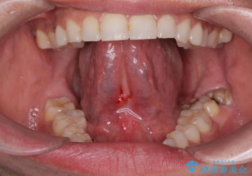 舌小帯切除術の症例 治療後