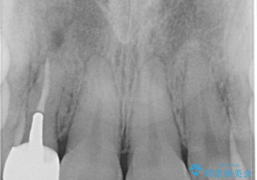 【オールセラミッククラウン】前歯の見た目が気になる!の治療後