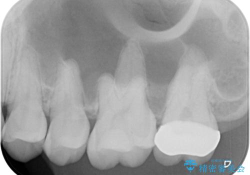 詰め物の下に虫歯があると言われた　オールセラミッククラウンの治療後