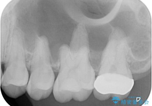 詰め物の下に虫歯があると言われた オールセラミッククラウンの治療後