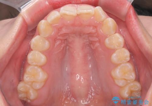 前歯の並び　インビザライン　非抜歯で　深いかみ合わせの治療の治療前