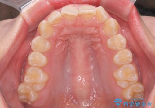 前歯の並び インビザライン 非抜歯で 深いかみ合わせの治療の治療前