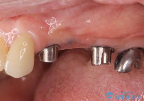 複数の奥歯の欠損 インプラントによる咬合機能回復の治療中