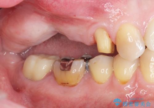 骨の造成を伴う奥歯のインプラント治療の治療前