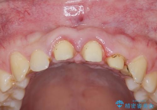歯周外科を行い、歯ぐきの状態を整えた前歯セラミック治療の治療前