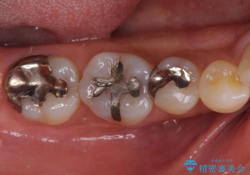 虫歯を治したい。ゴールドアンレーでの治療の症例 治療前