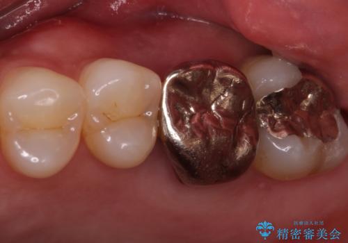奥歯が痛む ブリッジによる治療の治療前