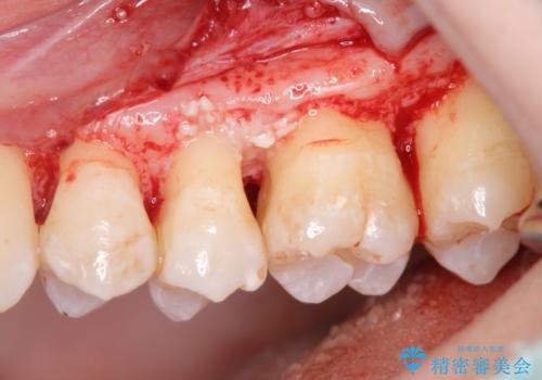 [ 歯周病 ]  歯槽骨の再生治療で歯を残すの治療中