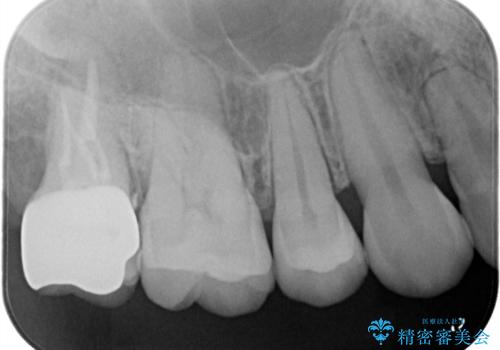 【オールセラミッククラウン】海外に転居する前に治療したいの治療後