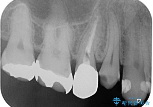 できるだけ歯質を残した1day治療 セラミックインレーの治療前