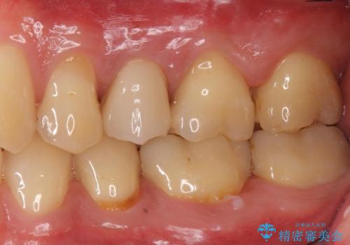 歯茎が腫れてきた。再根管治療の治療後