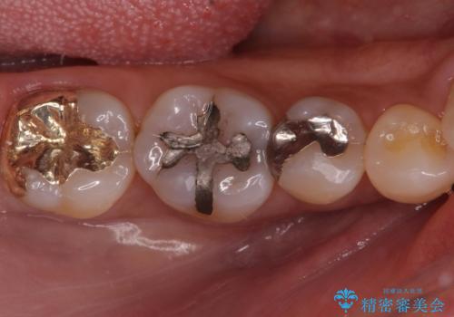 虫歯を治したい。ゴールドアンレーでの治療の症例 治療後