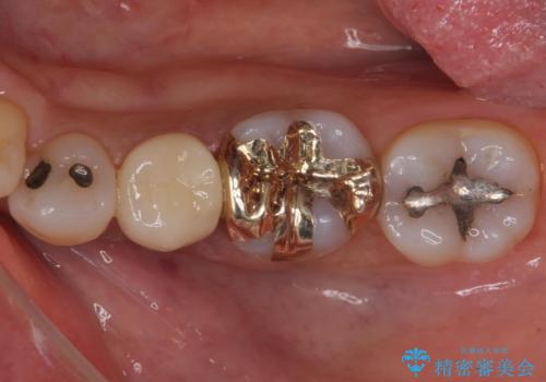 銀歯から精度の良い補綴物への症例 治療後