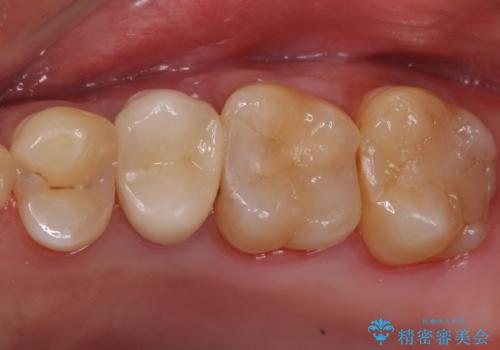 歯茎が腫れてきた。再根管治療の症例 治療後