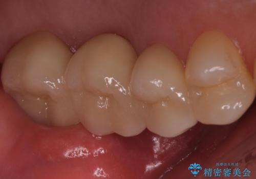 奥歯が痛む　ブリッジによる治療の治療後