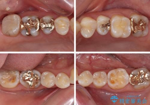 奥歯の銀歯をゴールドでしっかりと治療