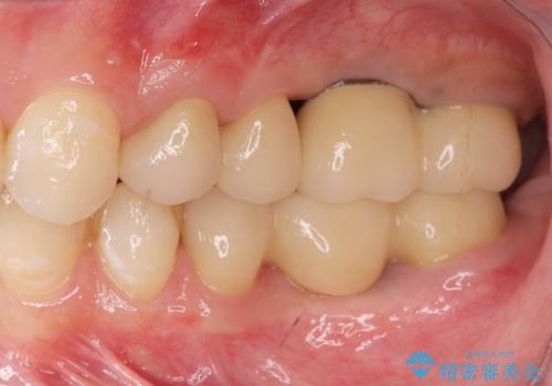 虫歯・破折の放置により重度に吸収した歯槽骨 骨造成後のインプラント治療の治療後