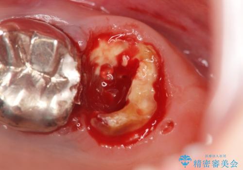 虫歯・破折の放置により重度に吸収した歯槽骨 骨造成後のインプラント治療の治療前