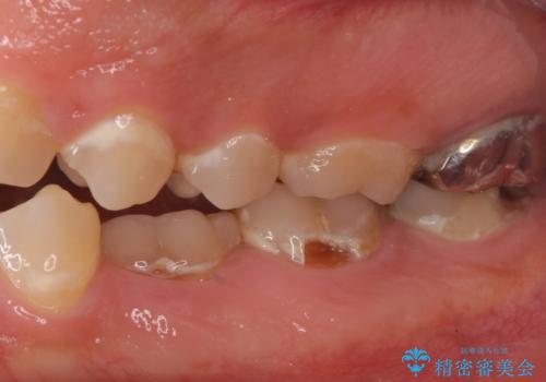 できる限り口の中を綺麗にしたい。の治療前