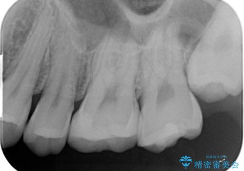 コンタクトカリエス治療。の治療後