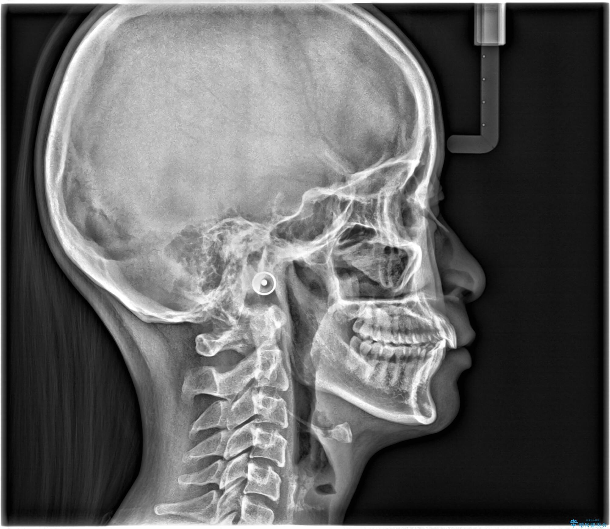 【インビザライン】前歯を下げたい。の治療後(顔貌)