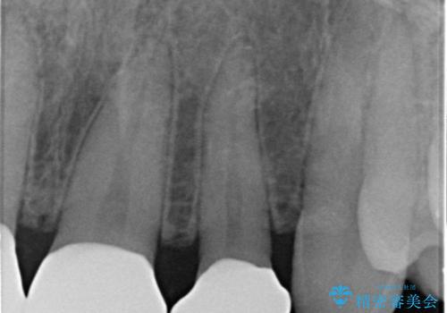 前歯の隙間を埋めたい 矯正かクラウンかの治療後