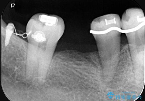 【再生治療】歯がぐらぐらして怖いの症例 治療後