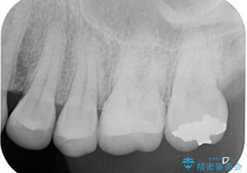 奥歯を白くしたいの治療後