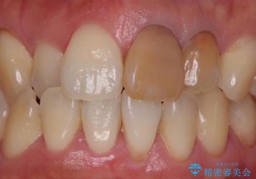 変色した前歯を治したい。ジルコニアクラウンでの修復の症例 治療前
