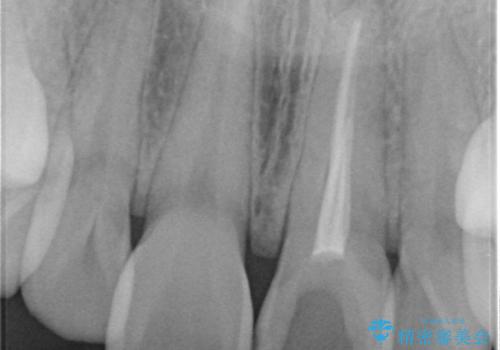 前歯が暗く変色 ジルコニアクラウンでの修復の治療前