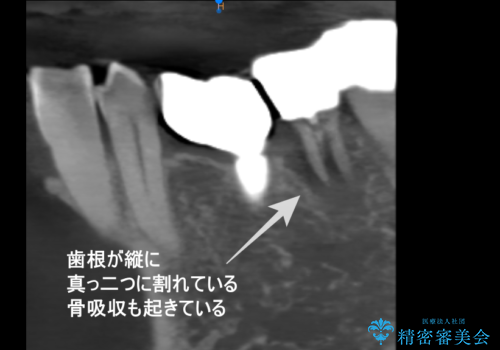 【1Dayインプラント治療!　低侵襲で短期間での治療】　咬むと歯が痛い!　歯根破折の治療前