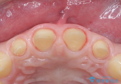 前歯の隙間を埋めたい　矯正かクラウンかの治療中