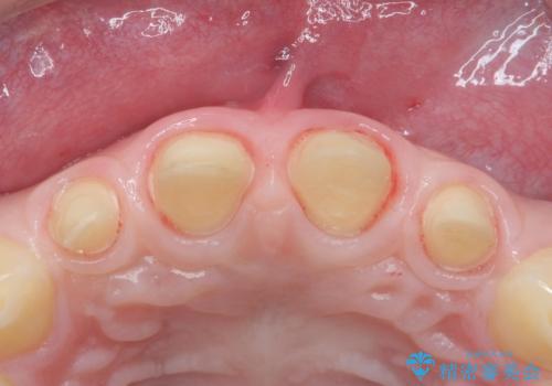 前歯の隙間を埋めたい 矯正かクラウンかの治療中