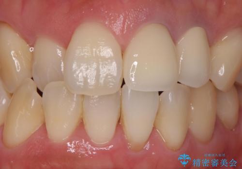 変色した前歯を治したい。ジルコニアクラウンでの修復の症例 治療後